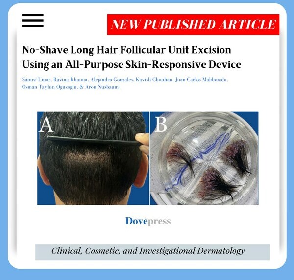 Donor area is shown soon after long-hair FUE using the UGraft Zeus (A). Long-shafted grafts from a straight-haired individual (B).