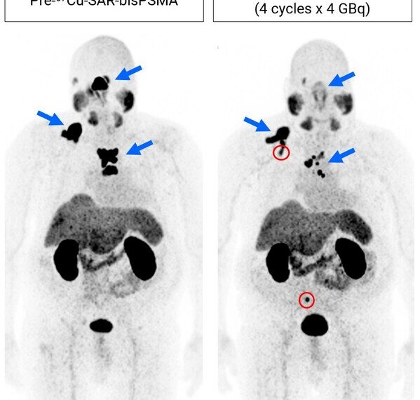 Figure 1. Images show considerable reduction in lesion uptake (64Cu-SAR-bisPSMA PET) following 4 doses of 67Cu-SAR-bisPSMA (4GBq each; PET conducted in July 2024, approximately 14 months post-fourth cycle). Reduction in uptake (maximum standardised uptake value [SUVmax]) and tumour volume: 72.5% and 41.6%, respectively. New bone lesions identified (red circles) in the most recent image prior to the fifth dose. The fifth dose was delivered on 30 July 2024, with PSA having fallen 47.5% as of 24 September 2024 and trending downward. Post-treatment scans are pending.